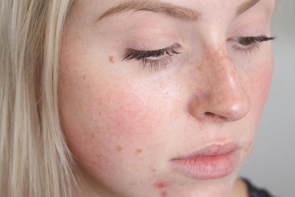 Розовые прыщи