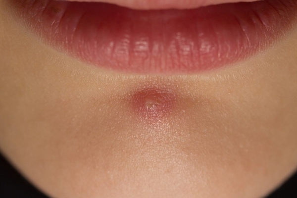 Простудный прыщ