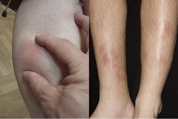 Узловая эритема