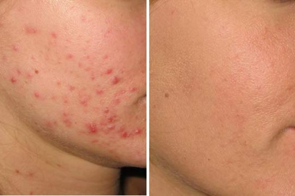 Применение йода (фото "до" и "после" лечения)