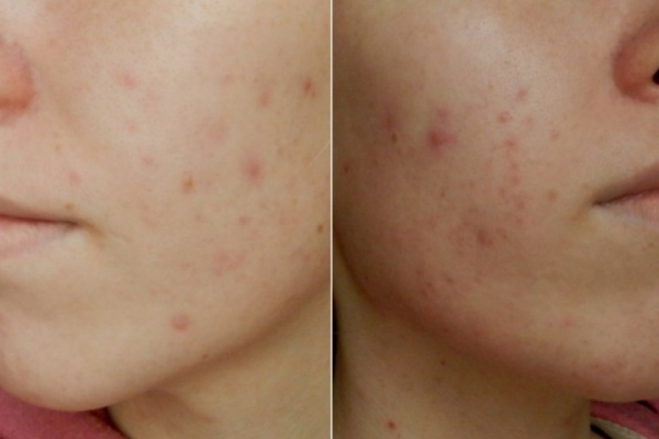 Результат использования соды