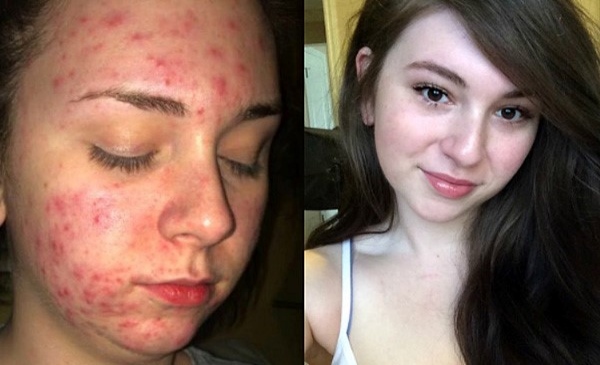 До и после лечения прыщей Юнидоксом