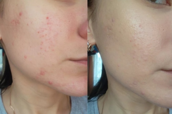 Фото до и после применения Хлорофиллипта