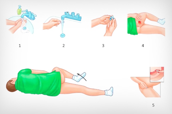 Введение ректальных свечей