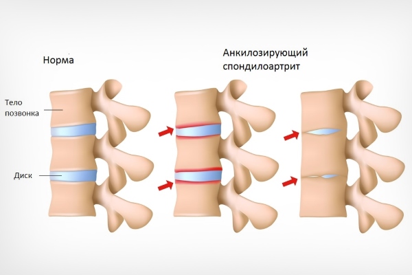 Болезнь Бехтерева