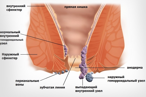 Внутренний и наружный геморрой