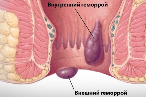 Внутренний и наружный геморрой