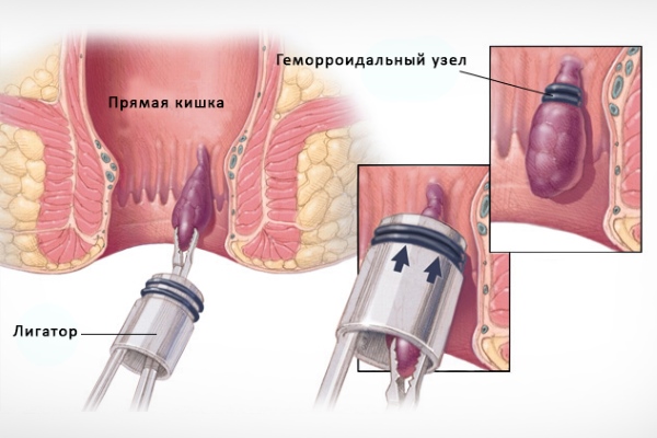 Лигирование геморроидальных узлов