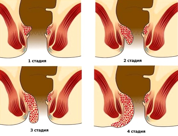 Стадии геморроя