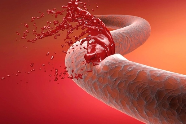 Кровотечение