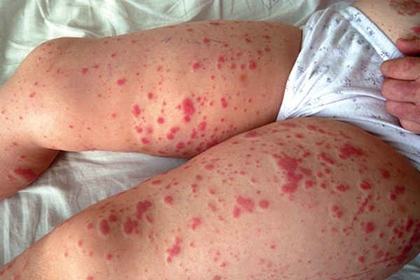 Геморрагическая сыпь у детей