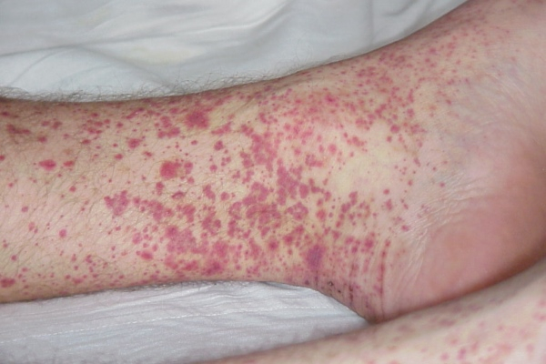 Симптомы геморрагического васкулита