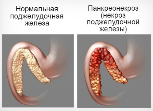 Геморрагический панкреонекроз