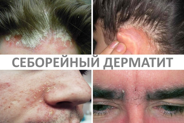 Себорейный дерматит