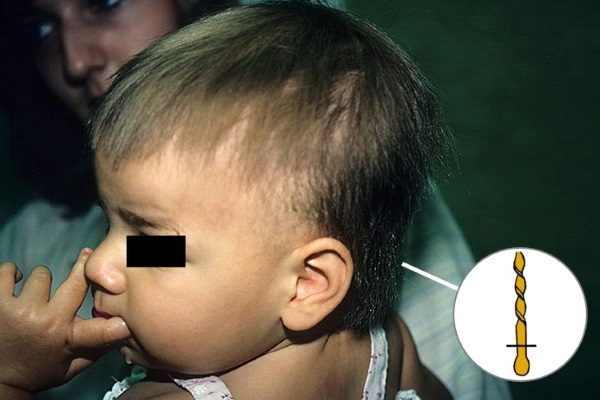 Трихокинез