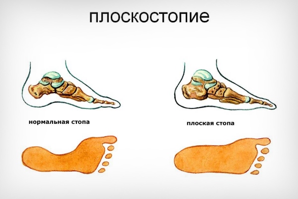 Норма и плоскостопие