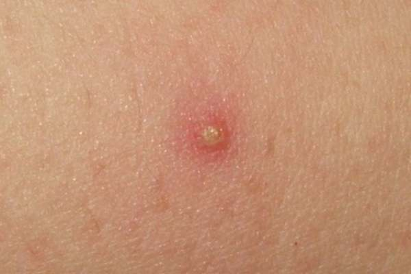 Фолликулит на коже