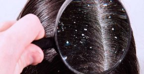 Как избавиться от перхоти в домашних условиях? Лучшие рецепты от разных видов заболевания