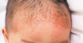 Почему у детей появляется себорея и как ее лечить?