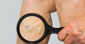 Чем связан тромбофлебит и варикоз: причины появления, сравнение симптоматики, способы лечения и профилактика